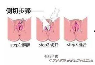 会阴侧切视频,手术过程及注意事项